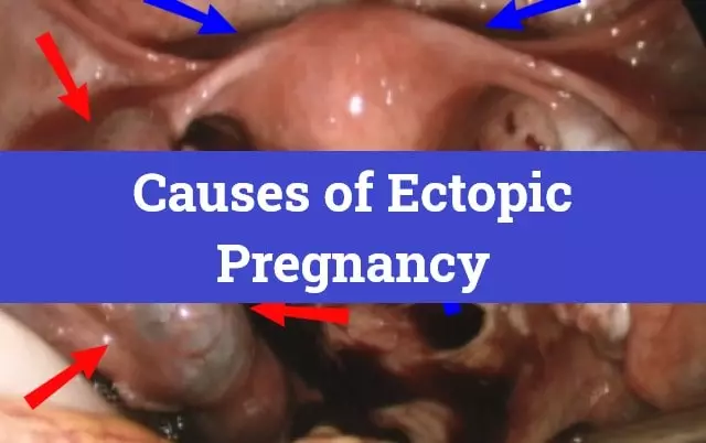 Causes of Ectopic Pregnancy