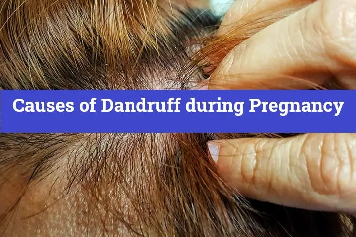 Causes of Dandruff during Pregnancy