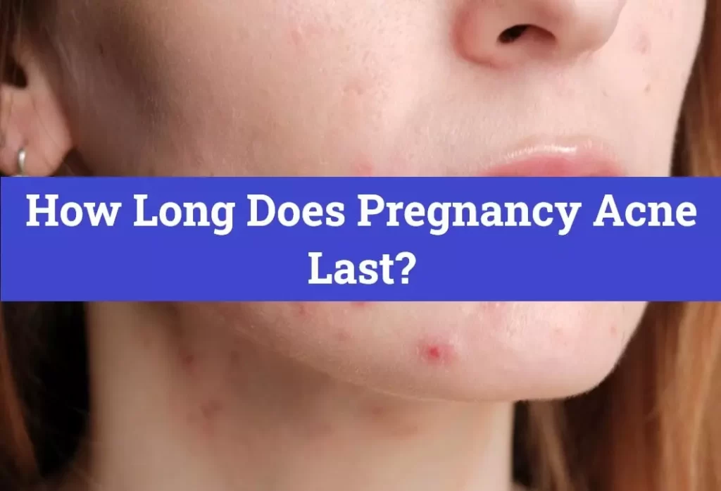 How Long Does Pregnancy Acne Last