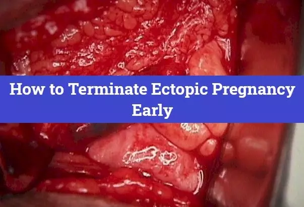 How to Terminate Ectopic Pregnancy Early